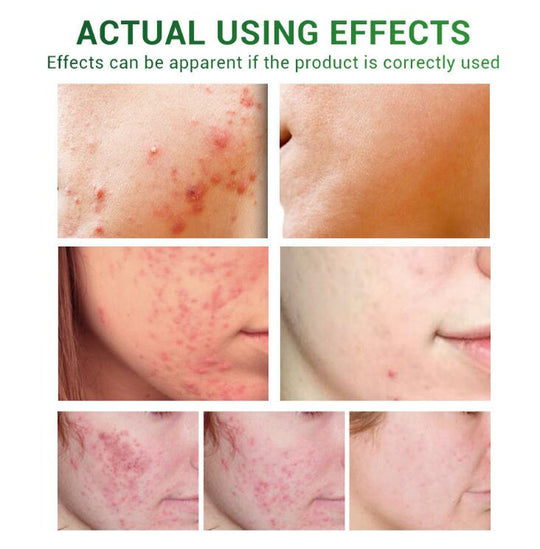 Acne Treatment Serum Facial Repair Oil for smoother skin