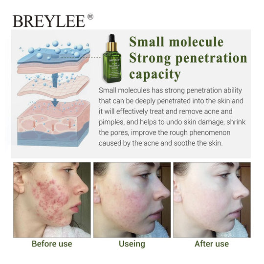 BREYLEE Acne Treatment Serum for Acne Scar &amp; Pimple Repair before and after skin results images with strong penetration capacity.