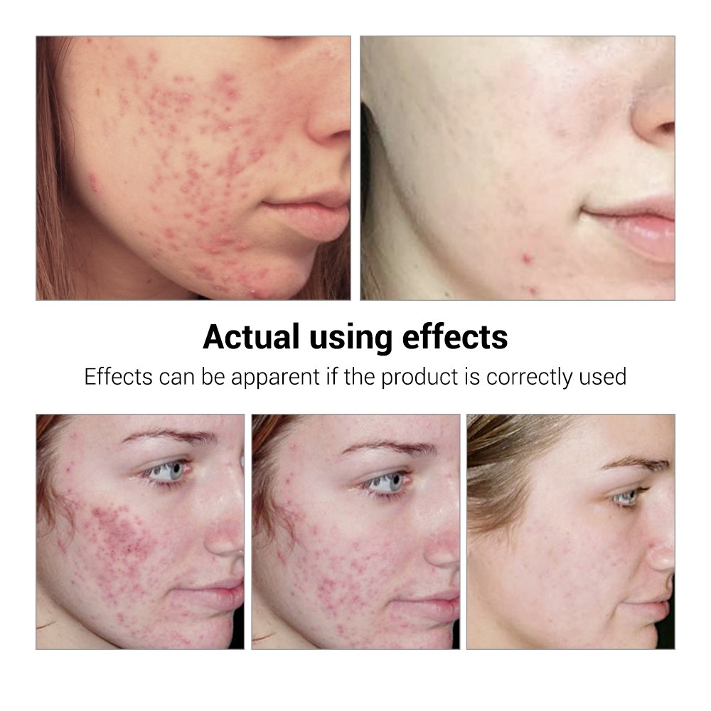 Før og etter bilder av BREYLEE Acne Treatment Serum for Acne Scar & Pimple Repair, synlig forbedring i akne.