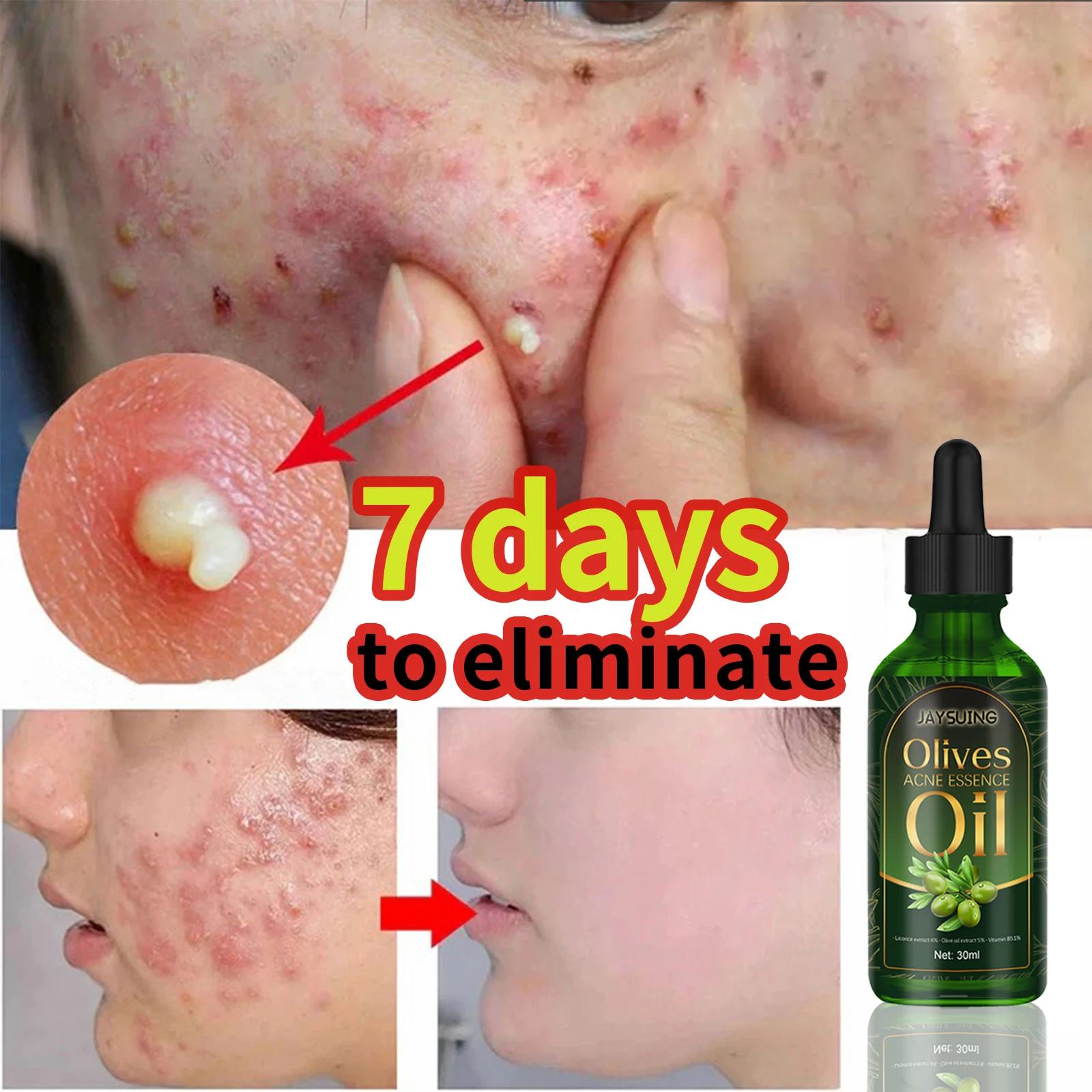 Acne Clarifying Oil for acne-prone skin care