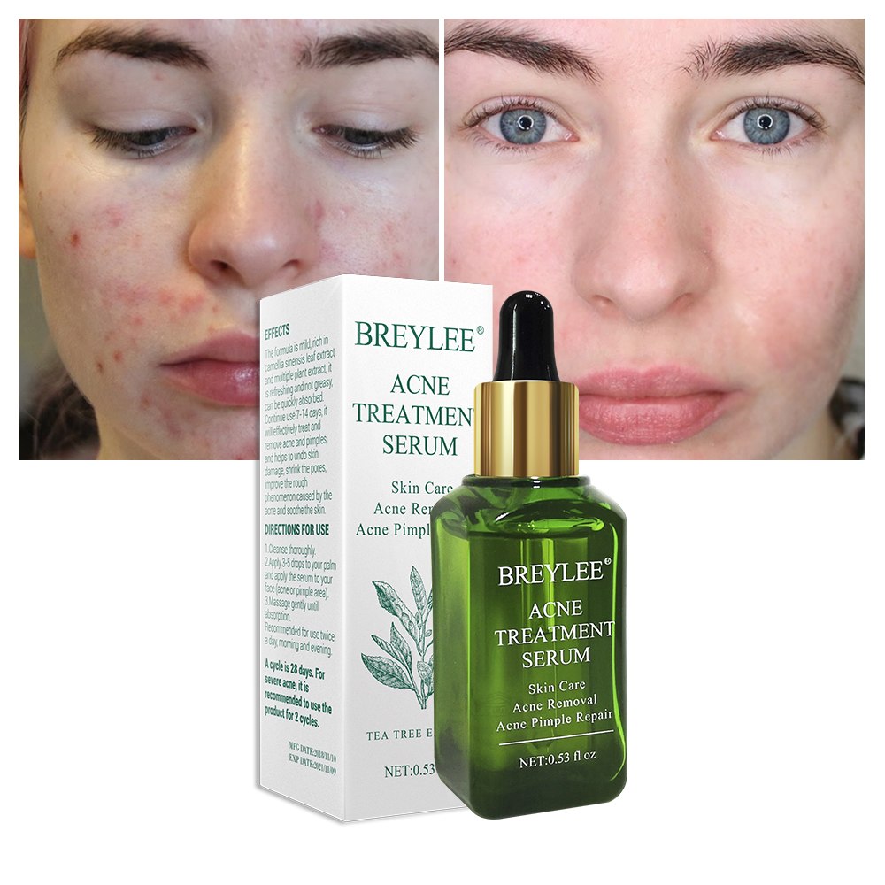 BREYLEE Acne Treatment Serum for Acne Scar &amp; Pimple Repair shown before and after results with packaging.