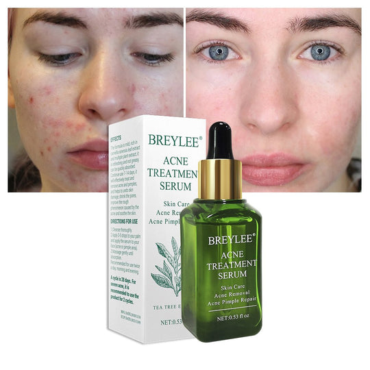 BREYLEE Acne Treatment Serum for Acne Scar &amp; Pimple Repair shown before and after results with packaging.